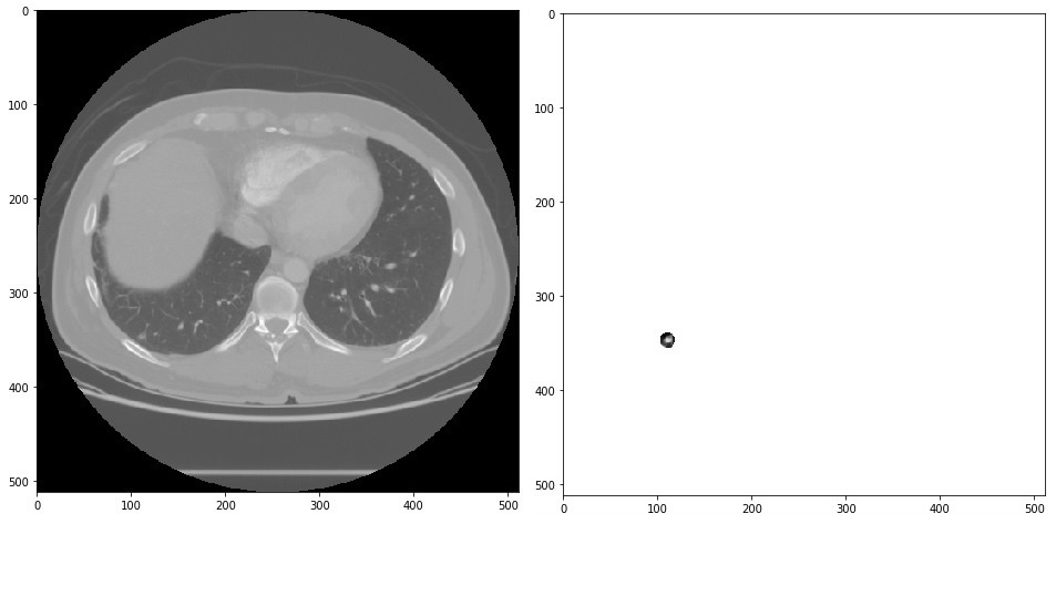 Deep learning applied to medical image analysis and diagnosis shown in figure. The image on the left is a slice of a CT lung containing a small nodule. The image on the right shows the detected nodule only.